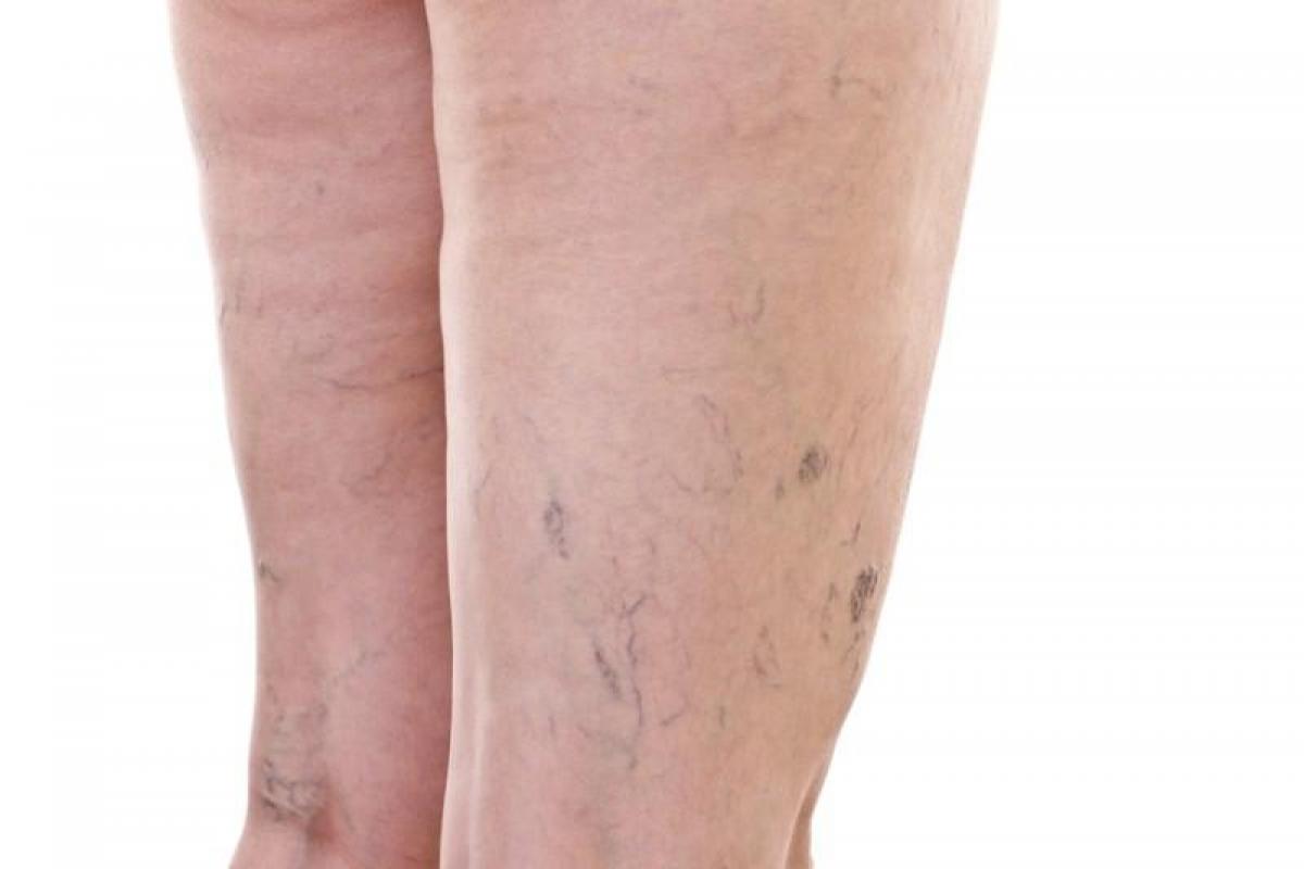 Spider Veins