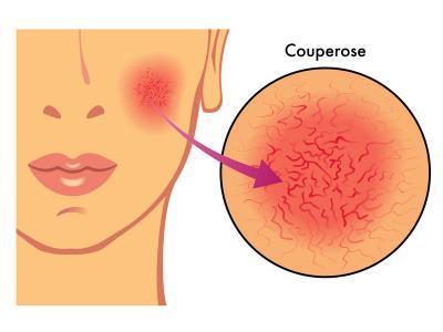 Couperose